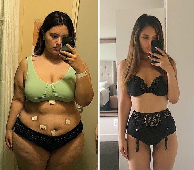 Girl before and after weight loss with KETO Complete capsules
